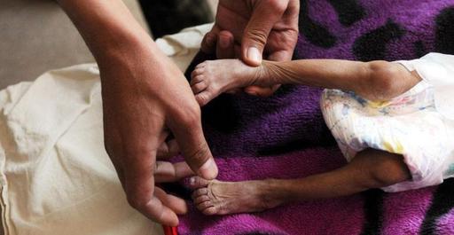 Йемен халқының 80%-ы аштыққа ұрынды